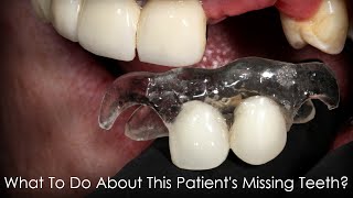 What to do About This Patients Missing Teeth [upl. by Esinal222]