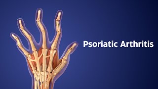 Title Understanding Psoriatic Arthritis Symptoms Treatment and Early Signs [upl. by Reivad]