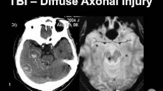 Diagnosing Brain Hemorrhages [upl. by Krystalle708]