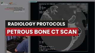 Petrous bone CT Protocol A Radiology Techs Video Guide [upl. by Ahsotan]