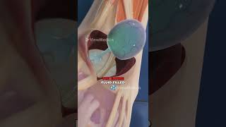 Ganglion Cyst Removal 3D Animation [upl. by Einafit]