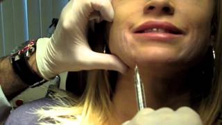 Cannula Method for Fillers  Dr Nissan Pilest Irvine CA [upl. by Meneau]