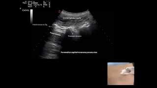 Ultrasound guided facet joint injection by Murat Karkucak MD [upl. by Hsetim]