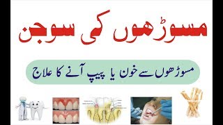 Masooron ki sujan ka ilaj  Pyorrhea treatment at home Urdu  Pyorrhoea ka gharelu ilaj [upl. by Ailaza]