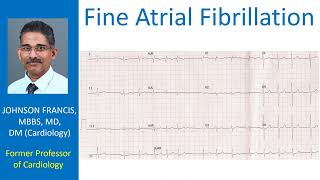 Fine Atrial Fibrillation [upl. by Eimaral]