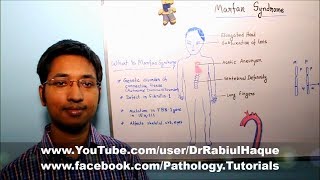 Marfan Syndrome  Part 2 HD [upl. by Henka]