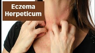 What is Eczema Herpeticum  Eczema Natural Healing [upl. by Ramoj276]