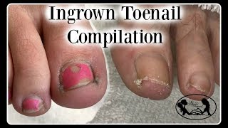 Satisfying Ingrown Toenail Pedicure Compilation [upl. by Fulcher99]