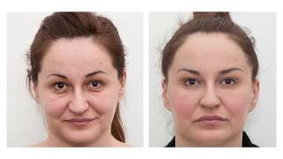 The results of dermal fillers before and after [upl. by Phelia]