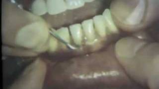 Scaling and Root Planing Part II Mandibular Teeth [upl. by Lonyer]