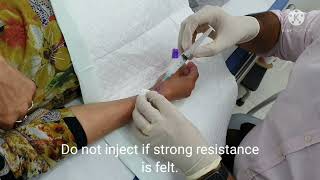 WRIST DEQUERVAINS STEROID INJECTION DR PRADEEP BALA [upl. by Attesoj724]