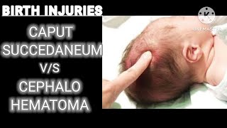 caput succedaneum VS cephalohematoma  AIIMS NORCET 5  ESIC  DSSSB  PGI  SGPGI  NURSING [upl. by Yeoz]