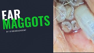 EAR MAGGOTS COMPLETE VIDEO  FULL TREATMENT [upl. by Laeria]