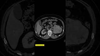 Renal Cell CarcinomaRCCCt scanphonkytribuphonkbr onepunchmandemonslayerphonkpphonkactivated [upl. by Eadwine745]