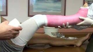 application of a long leg cast [upl. by Ahsimed]