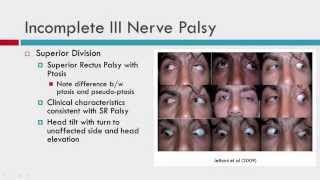 IIIrd CN Palsy Clinical Characteristics [upl. by Ihsakat]