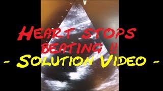 Cardiology Echo QuizCase Heart stops beating Part 2 Solution video [upl. by Nesto]