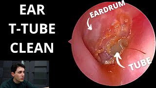 Tympanostomy Tube Cleaned Eardrum Tube [upl. by Conley]