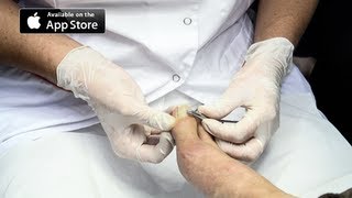 Ingrown Toenail Removal Surgery [upl. by Ovid]