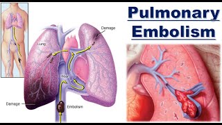 Pulmonary embolism [upl. by Prudi]