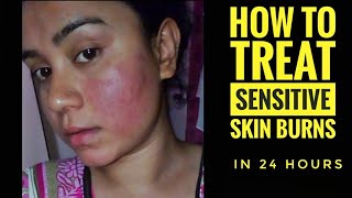 My SENSITIVE SKIN BURNS amp ALLERGIES Live Treatment Sensitive skin home remedies  Lovebeautybee [upl. by Anert651]