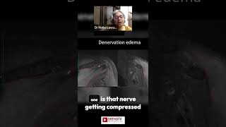 Denervation Edema  Dr Malini Lawande [upl. by Beattie]