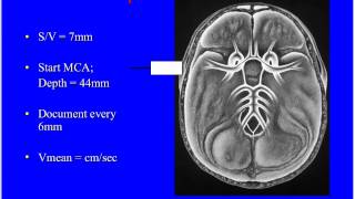 Natus TCD Webinar Transcranial Doppler and SAH [upl. by Koerner]