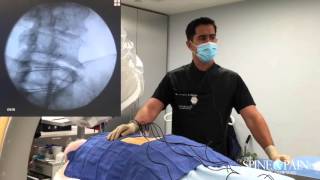 Radiofrequency Ablation Procedure [upl. by Kenweigh]