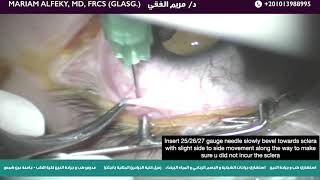 Posterior subtenon steroid injection [upl. by Nuahc]