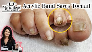 How to Fix a Pincer Toenail with Acrylic Journey [upl. by Kiernan133]