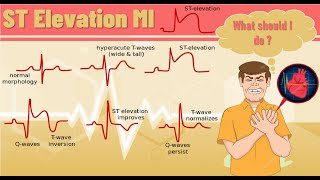 ST elevation myocardial infarction STEMI  ST elevation MI pathophysiology ECG finding and example [upl. by Dust]