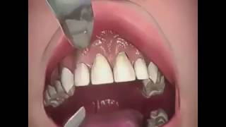 Gum Graft Dental Surgery [upl. by Atilrahc]