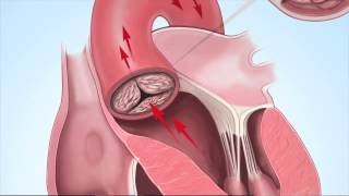 Understanding Aortic Stenosis with Dr Marc Gillinov [upl. by Hazeghi]