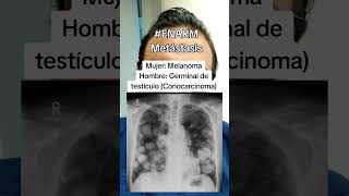 Metástasis pulmonares mir enarm usmle visita doctorvagocom [upl. by Waldron640]