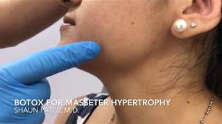 Botox treatment of the masseter muscle by Dr Shaun Patel in Miami Florida [upl. by Alekram382]