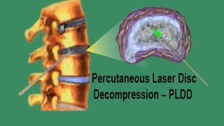 PLDD  Percutaneous Laser Disc Decompression [upl. by Onra]