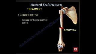 Humerus Fractures  Everything You Need To Know  Dr Nabil Ebraheim [upl. by Dur952]