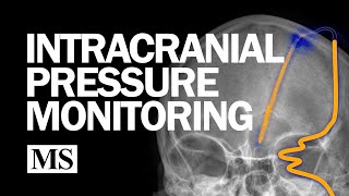 External Ventricular Drainage and Intracranial Pressure Monitoring [upl. by Jenkel]