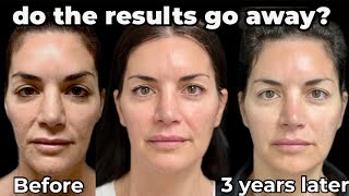 How Long does Sculptra Last Sculptra Face Transformation Before and After [upl. by Stalk]