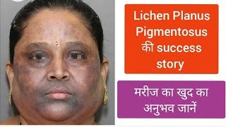 Lichen Planus Pigmentosus patient own experience LPP का इलाज lichenplanus LichenPlanusPigmentosus [upl. by Nosreve]