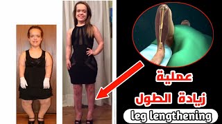 شاهد كيف تكون عملية زيادة الطول في الحقيقةHeight increase surgerylimb lengthing [upl. by Neelyam]