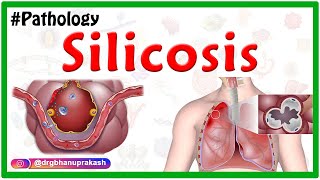 Silicosis Miners phthisis Grinders asthma  Etiology  Pathophysiology  Diagnosis Treatment [upl. by Bret]