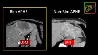 5 LIRADS Malignant lesions that are not definitely HCC LRM  Part 1 By Dr Kathryn Fowler [upl. by Laurence]