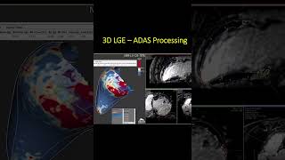 Cómo la Resonancia Cardíaca y el Software ADAS Transforman la Ablación de Taquicardia Ventricular [upl. by Tayyebeb]