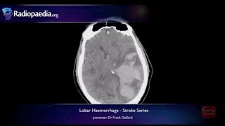 Stroke Lobar haemorrhage  radiology video tutorial MRI CT [upl. by Nuhsal262]