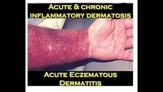 3b  Acute Eczematous Dermatitis [upl. by Mw]