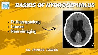 Basics of hydrocephalus [upl. by Norb]