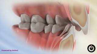 Deep Bite with Excessive Overjet  Dental Braces  Temecula Valley CA [upl. by Akinert]