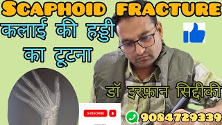 scaphoid fracture कलाई की हड्डी का टूटना डॉ इरफान सिद्दिकी [upl. by Iliam]