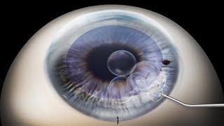 DMEK Descemets membrane endothelial keratoplasty animation [upl. by Frodi109]